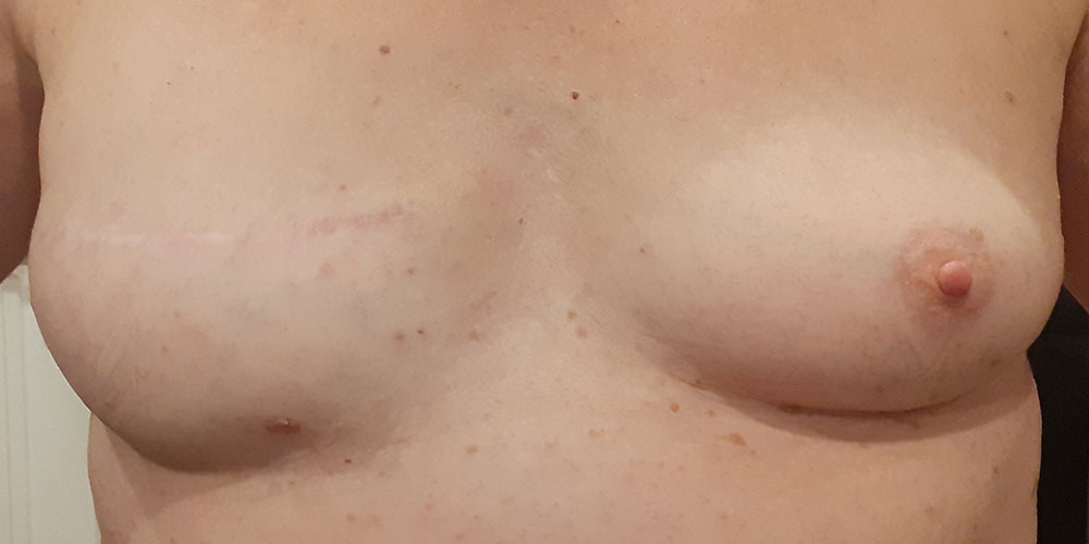 Poitrine après cancer du sein avant dermopigmentation réparatrice