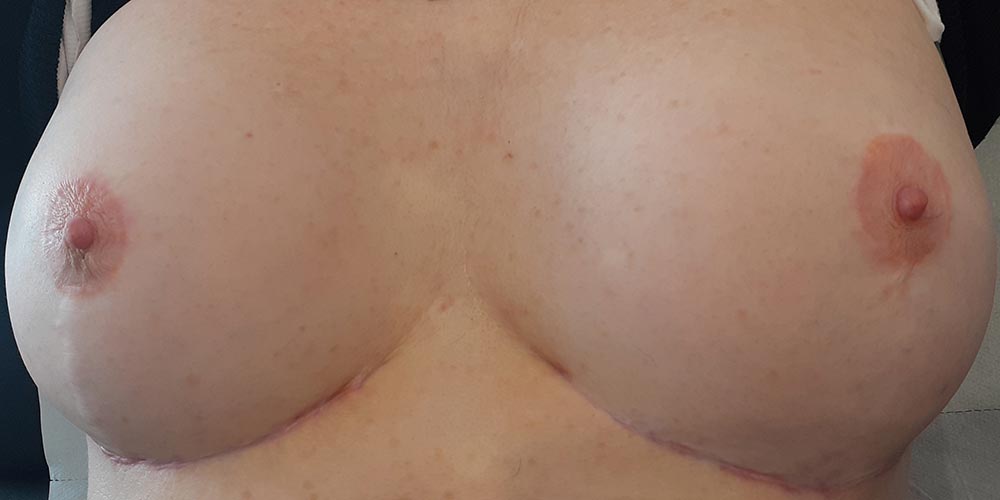 Poitrine avec prothèse mammaire après dermopigmentation réparatrice