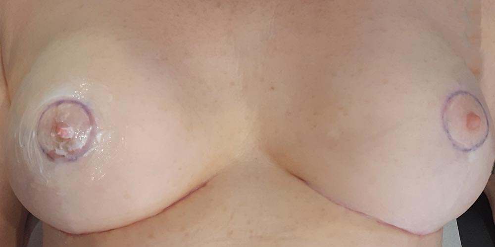 Poitrine avec prothèse mammaire avant dermopigmentation réparatrice