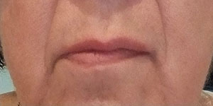 Sourire avant dermopigmentation des lèvres